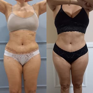 Pós Operatório e Drenagem Linfática - Dra Fernanda Bertoldo CRBM: 46954 em Tatuapé